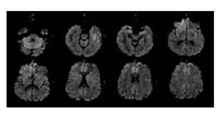 확산 강조 영상(Diffusion Weighted Imaging)